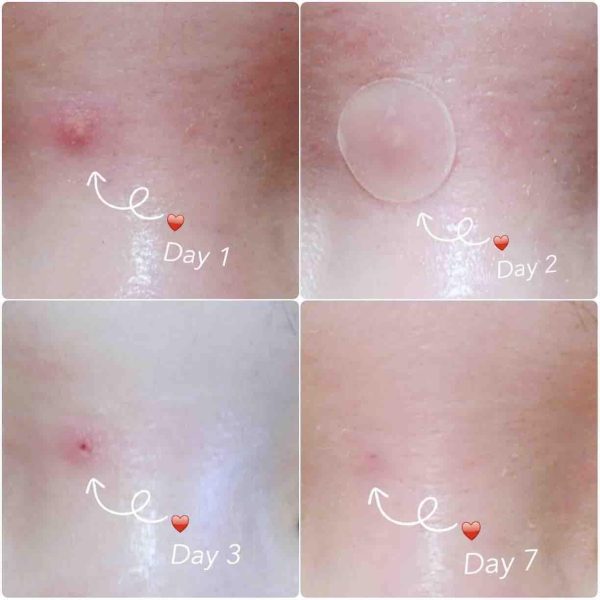 Acné Pimple Master Patch - COSRX - Imagen 4