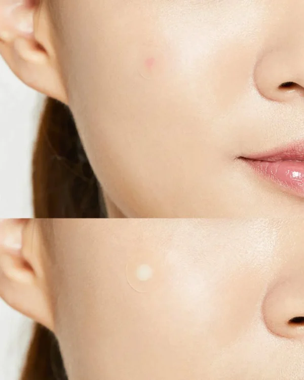 Acné Pimple Master Patch - COSRX - Imagen 3